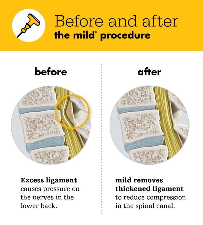 mild® procedure: before and after