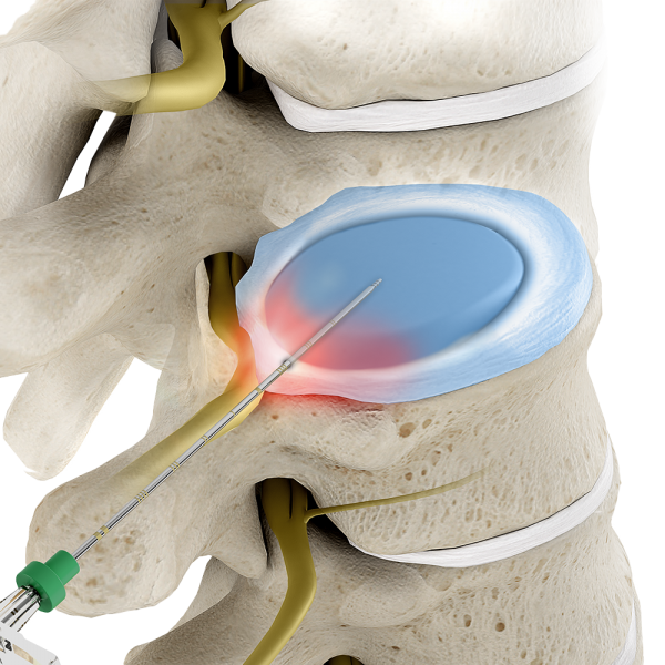 Disc decompression | Interventional Spine