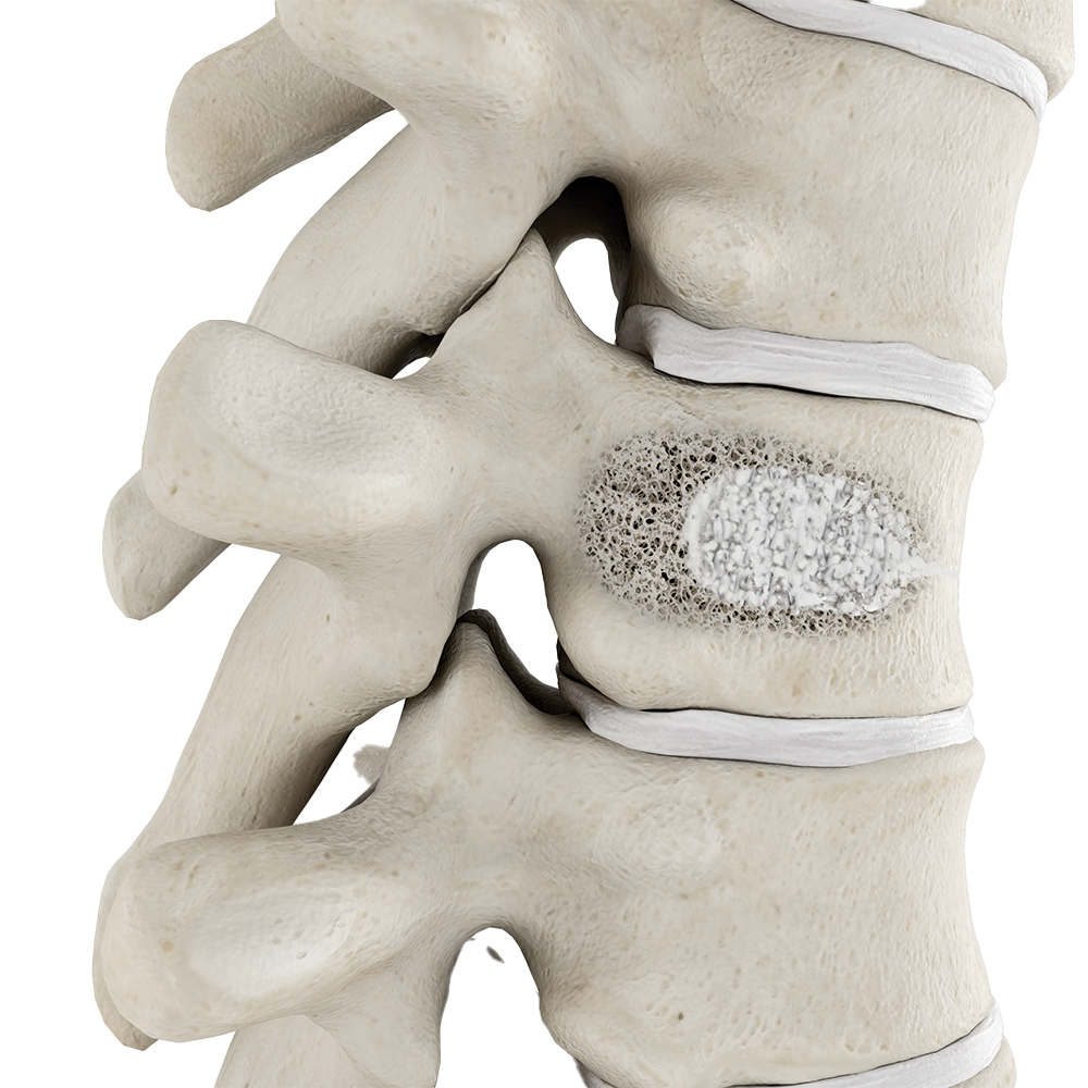 Vertebroplasty  Interventional Spine