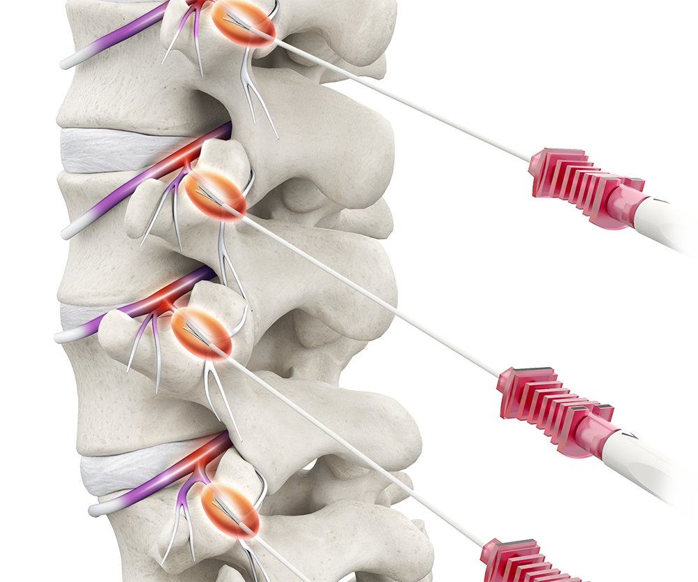 RF ablation  Interventional Spine