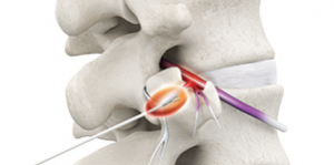 Rf Ablation Interventional Spine