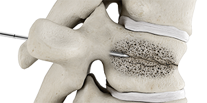 Vertebroplasty  Interventional Spine