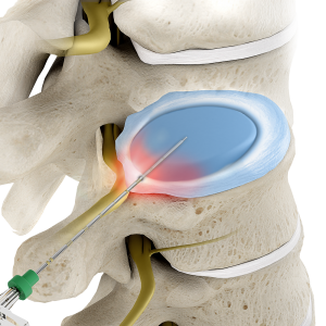 Disc decompression | Interventional Spine