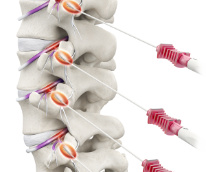 Venom cannula and electrode system | Interventional Spine