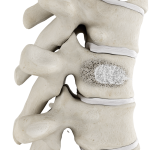 Vertebroplasty | Interventional Spine