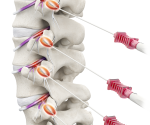 Venom Cannula And Electrode System 