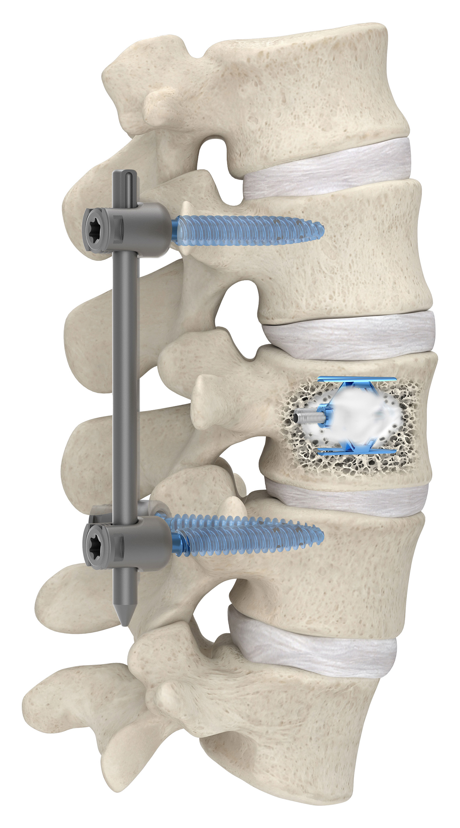 Why Choose Stryker IVS